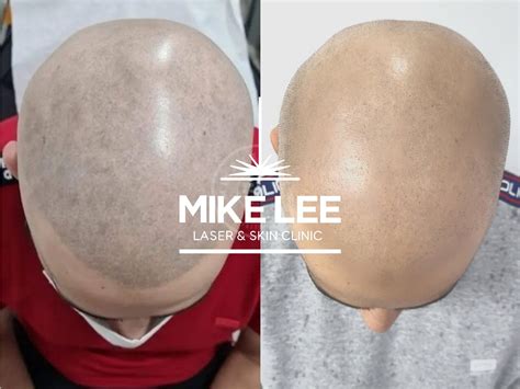 scalp micropigmentation removal.